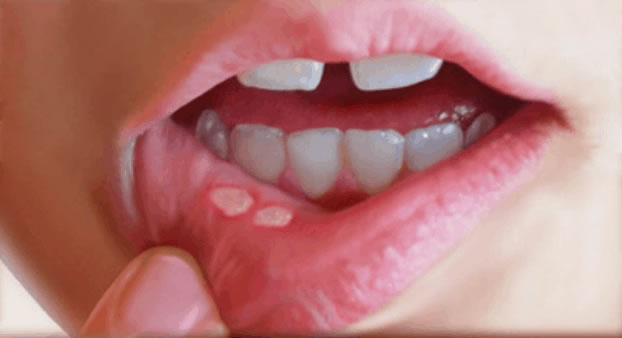 Consejos para evitar las llagas o aftas en la boca